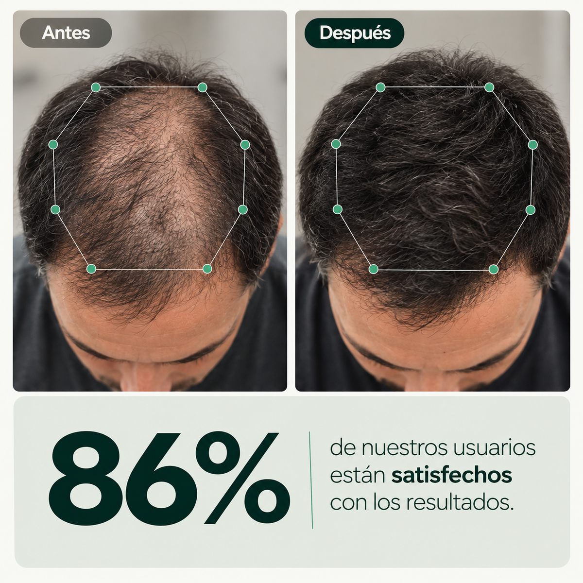Nidusinject - tratamiento para el crecimiento del cabello