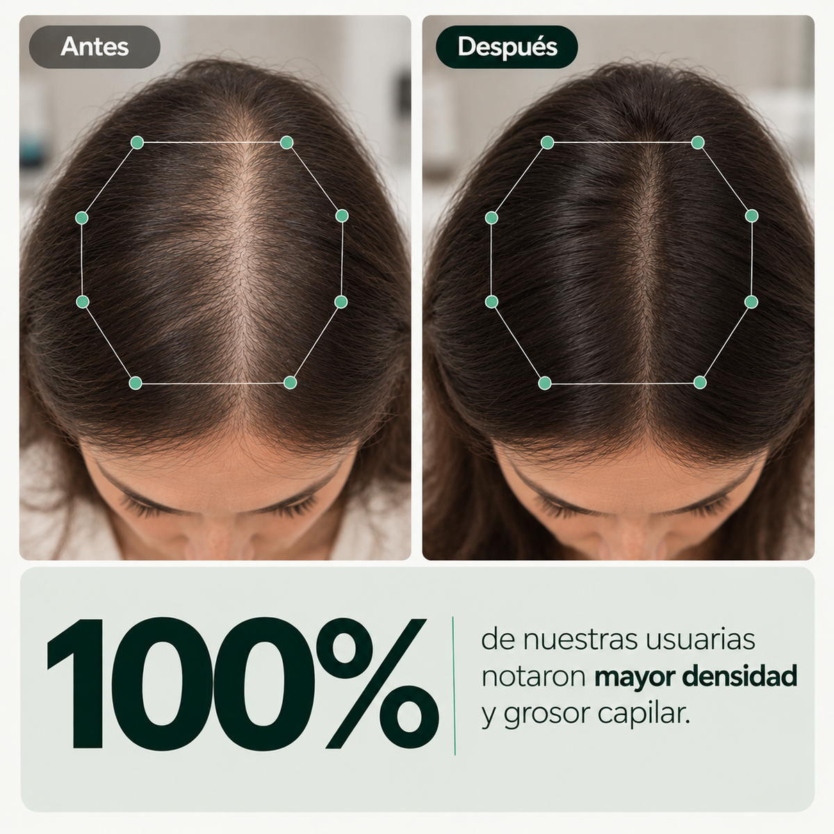 Nidusinject - tratamiento para el crecimiento del cabello